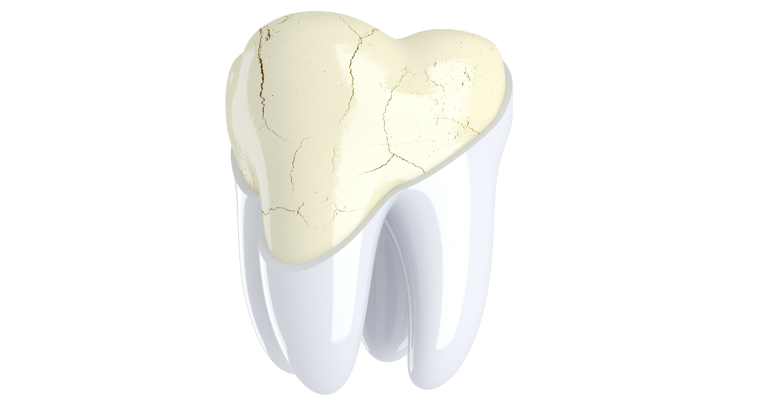 Dente demineralizzato: erosione dello smalto dentale