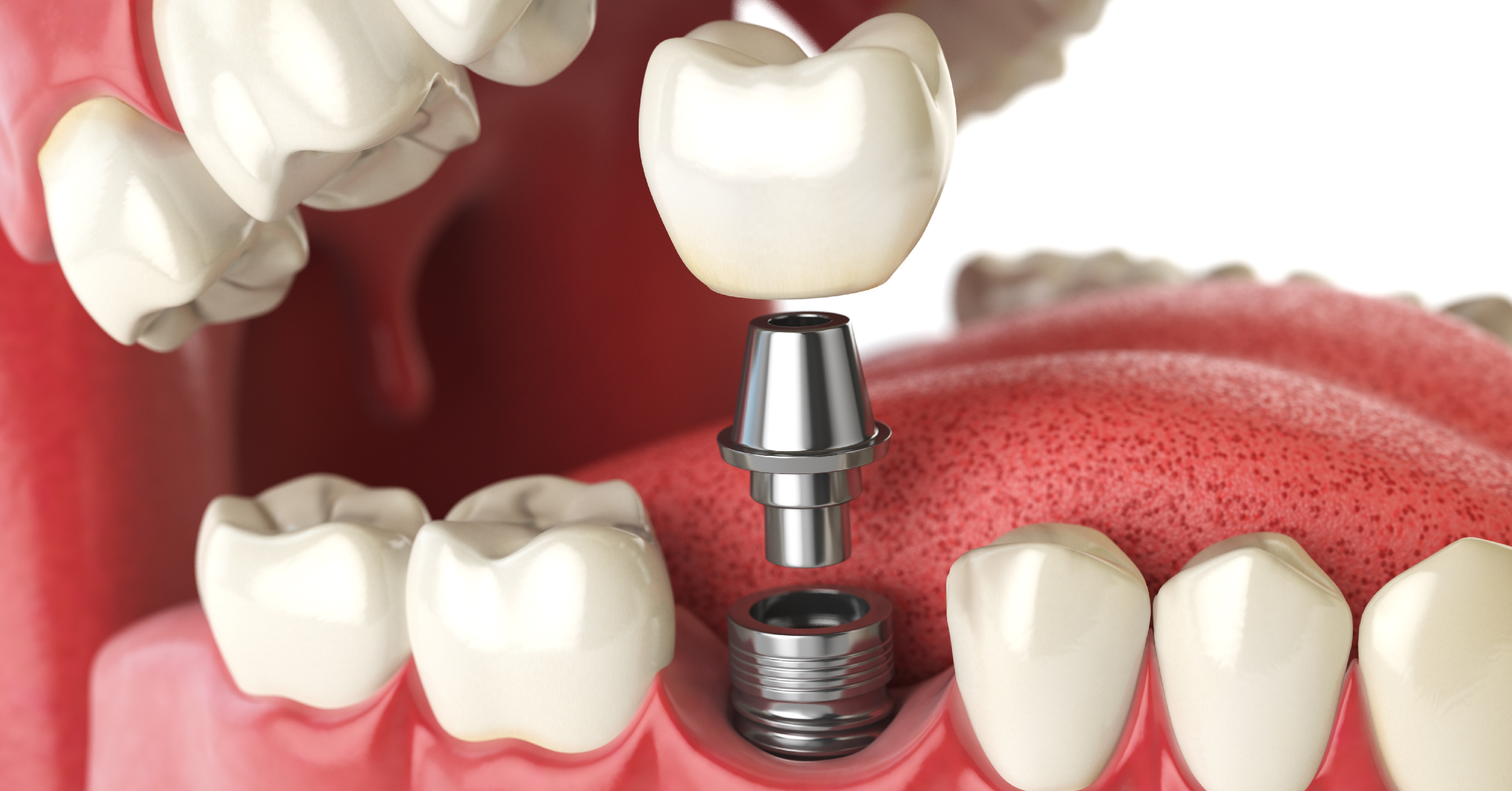 Impianti dentali: cosa sono, costi e rischi