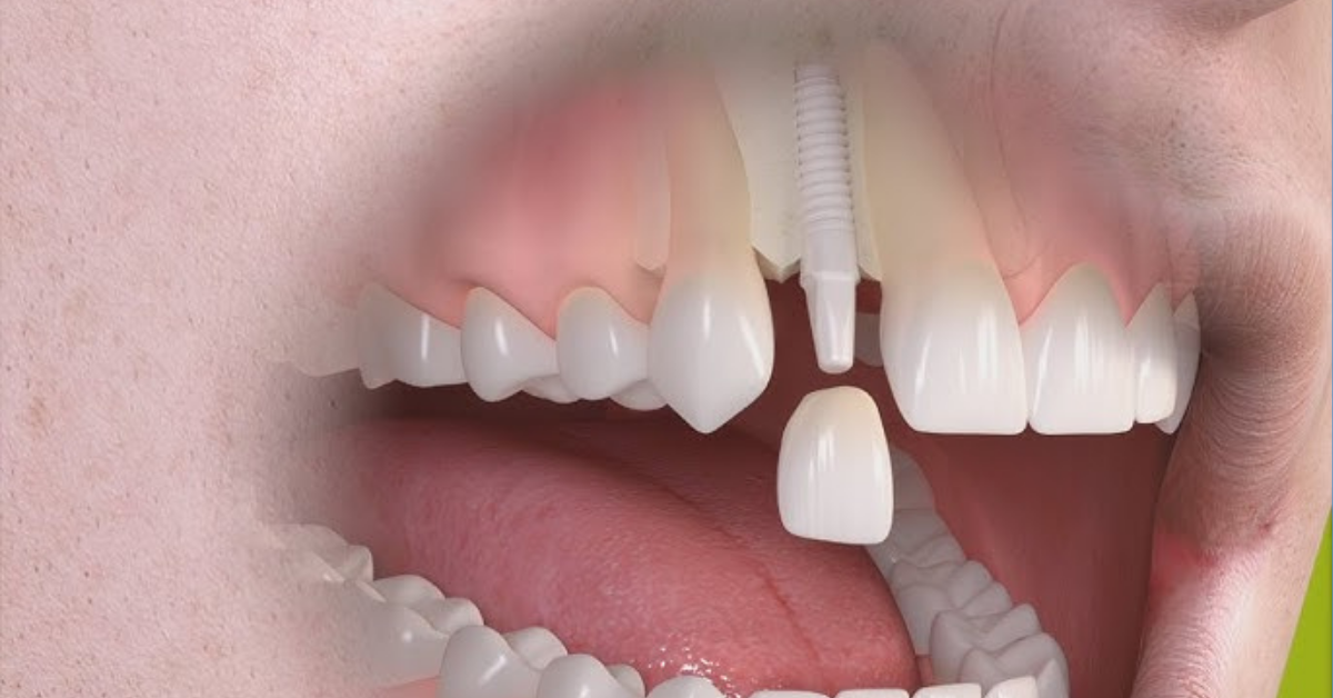 Impianti dentali in ceramica (zirconia): pro, contro e rischi da conoscere